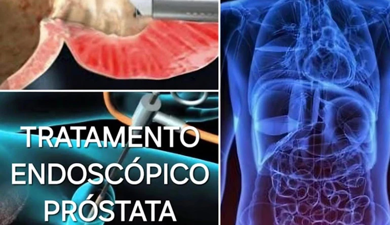 Ícone do tratamento de Cirurgia de Resseção Bipolar de próstata