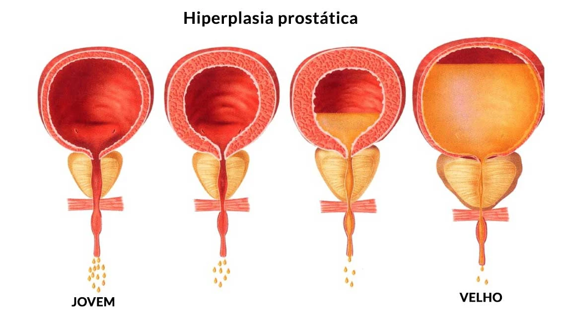Imagem do tratamento Hiperplasia prostática